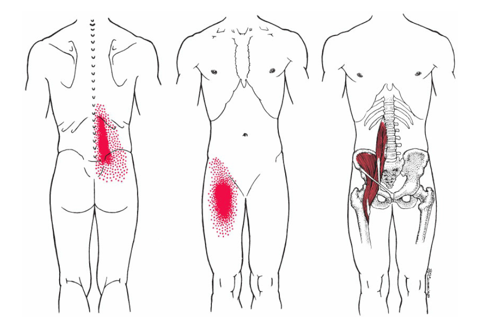 Lower Back Trigger Points A Key To Lower Back Pain Relief