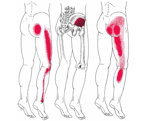 Sciatica Massage How Muscles Can Cause Relieve Sciatica
